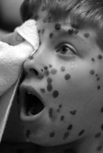 Chickenpox. Pain. / **********